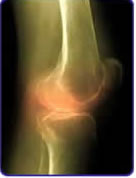 Eklemde şişlik iltihaplı romatizmanın habercisi
