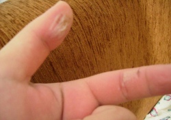 Yanık Deriye Mucizevi Çözüm