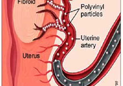 Damar tıkanıklığında müjde