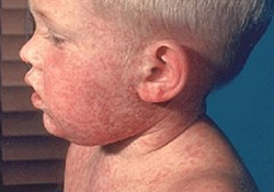 'Çiçek hastalığı' yine gündemde