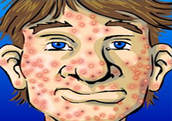 Çinko eksikliği akneye yol açıyor