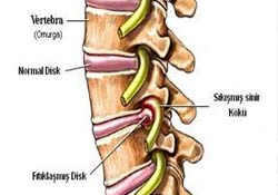 Bel fıtığından narkoz almadan kurtulun