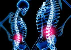 Her bel ağrısı fıtık mıdır?