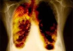 Her yıl 30 bin kişi akciğer kanseri