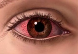 Güneydoğu'da 'kırmızı göz' salgını yayılıyor