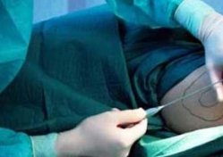 Liposuction ile alınan yağlar kollara dönüyor!
