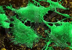 Yılda yirmi bin kişi mide kanserine yakalanıyor