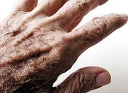 Parkinsonun korkunç sonucu!