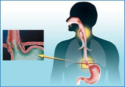 Kurban Bayramı’ndan sonra reflü şikayeti artıyor