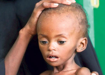 5 yaş altı 29 bin çocuk açlıktan öldü