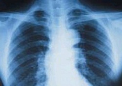 Midedeki iğne X-Ray ile ortaya çıktı