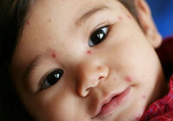 Kızamık vakalarında artış