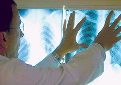 Gereksiz röntgen kanseri arttırıyor